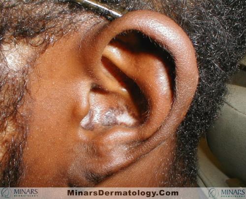 Discoid Lupus A
