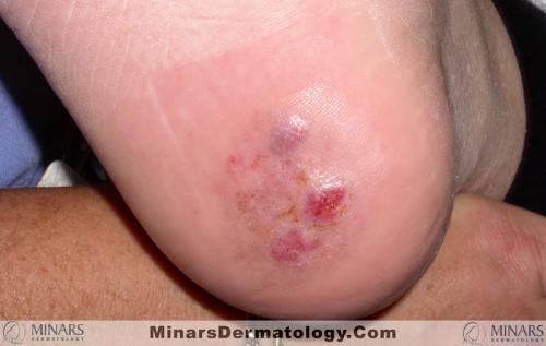 Eccrine Poroma A