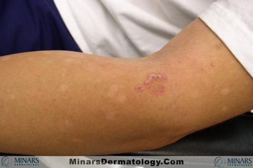 Elastosis perforans serpiginosa 01 A