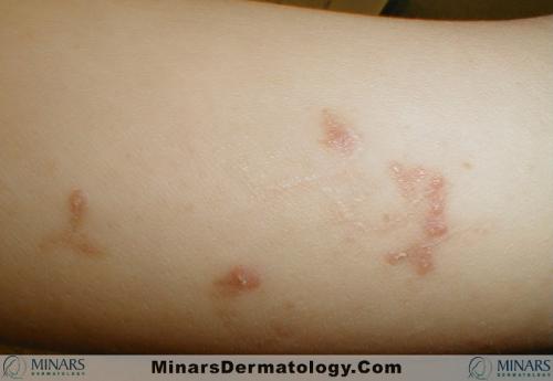 Elastosis perforans serpiginosa 03 A