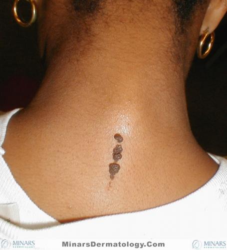 Epidermal Nevus 01 A