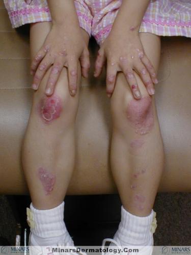 Epidermolysis Bullosa Simplex 01 A