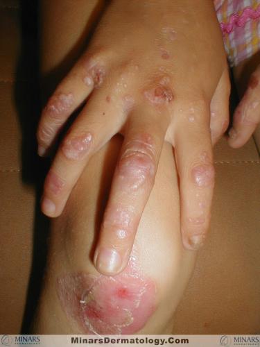 Epidermolysis Bullosa Simplex 02 A