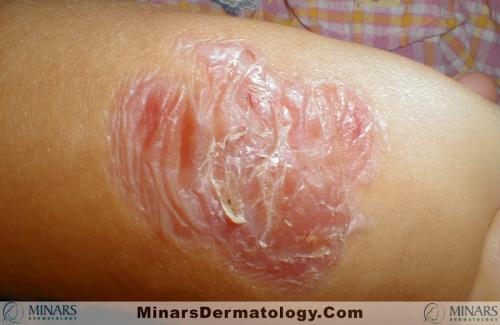 Epidermolysis Bullosa Simplex 03 A