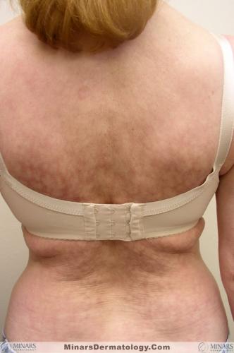 Erythema Ab Igne000A