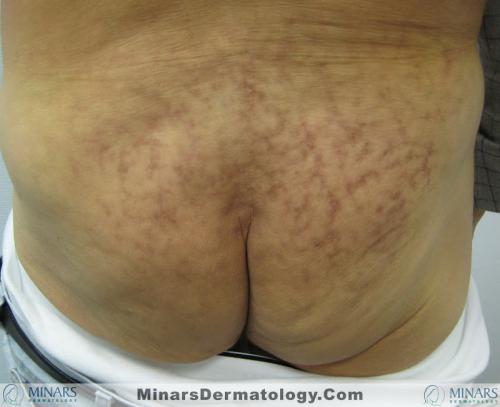 Erythema Ab Igne A
