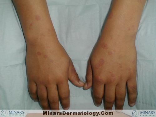 Erythema Multiforme