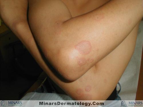 Erythema Multiforme2