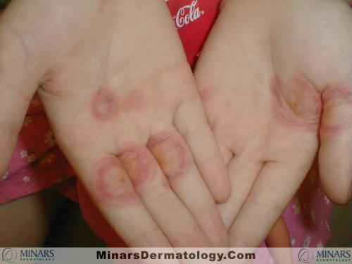 Erythema Multiforme 01 A