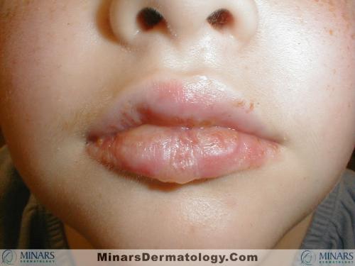 Erythema Multiforme A