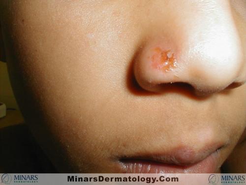 Erythema Multiforme HSV