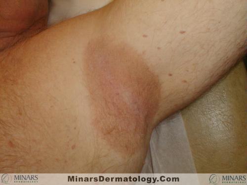 Erythrasma A