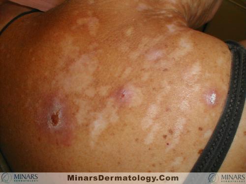 Excoriations A