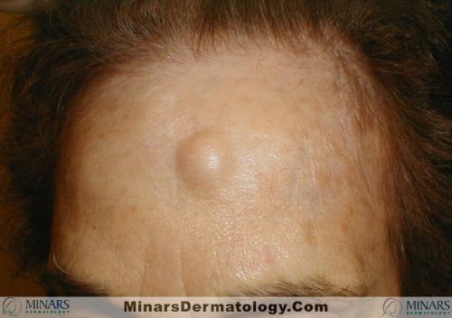 Exostosis A