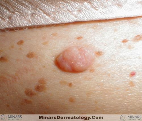 Firborepithelioma of Pinkus A