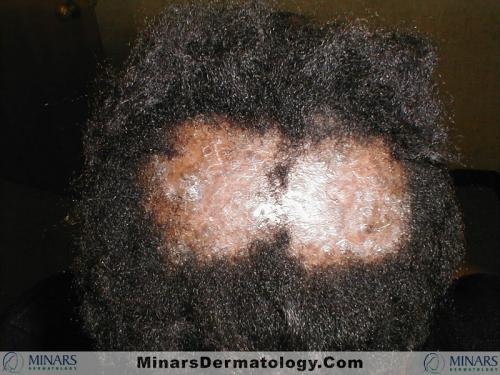 Folliculitis Decalvans A