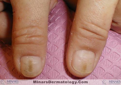 Habit Tic Deformity 2 A