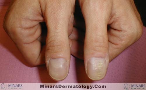 Habit Tic deformity A