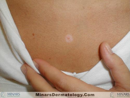 Halo Nevus A