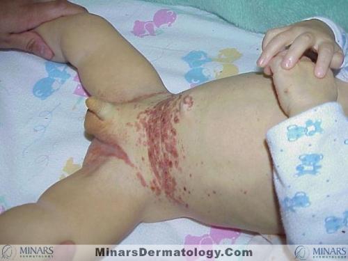 Histiocytosis X