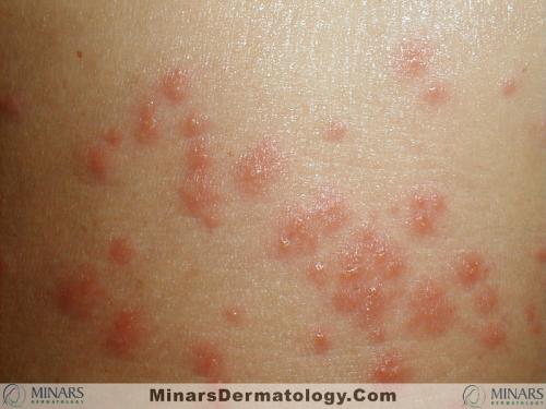 Insect bites 02 A