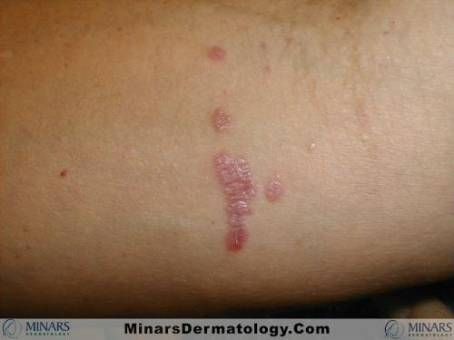 Lichen Planus 01 A