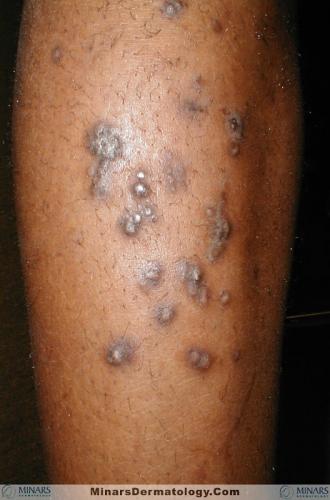 Lichen Planus Hypertrophic