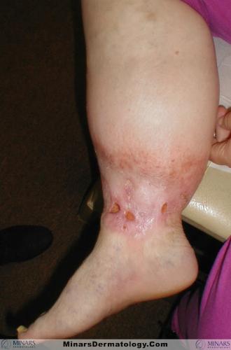 Lipodermatosclerosis A