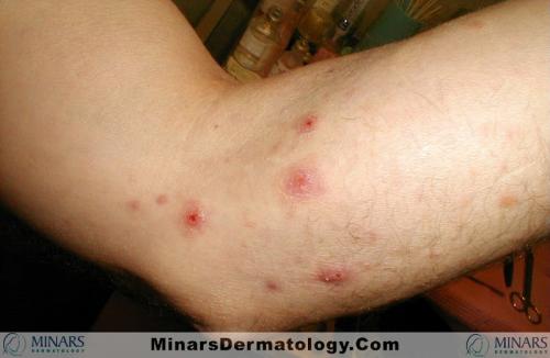 Lymphomatoid Papulosis A