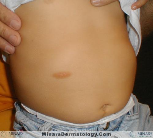 Mastocytoma 01 A