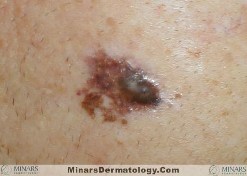 Melanoma 01 A