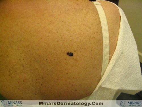 Melanoma 02 A