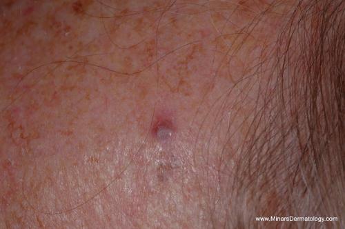 Metastatic Melanoma