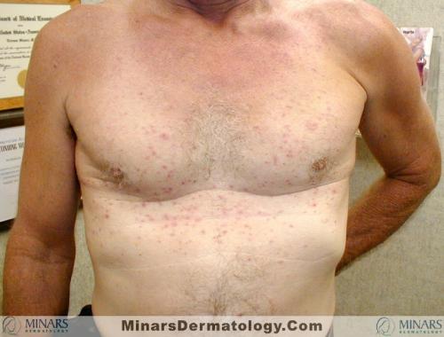 Miliaria A