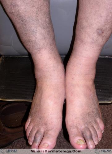 Minocycline Hyperpigmentation A
