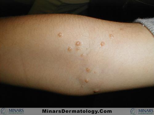 Molluscum Contagiosum A
