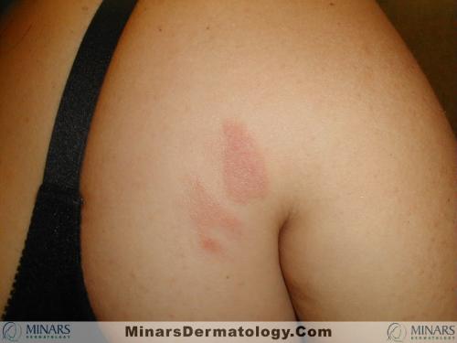 Mycosis Fungoides A