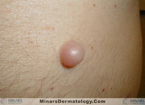 Neurofibroma A