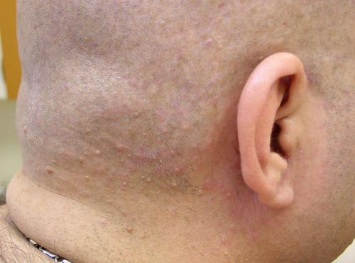Neurofibromatosis001