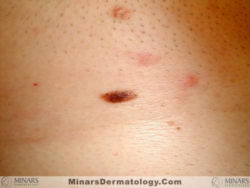 Nevus A