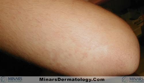 Nevus Anemicus A