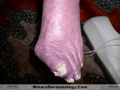 Norweigian Scabies aft1