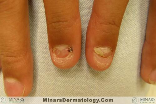 Onychodystrophy A