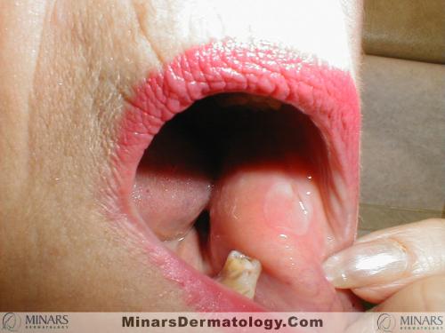 Pemphigus A