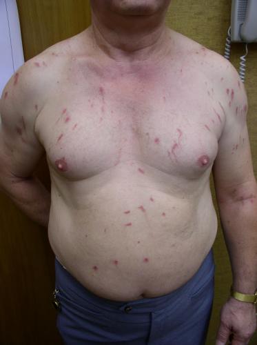 Phytophotodermatitis1