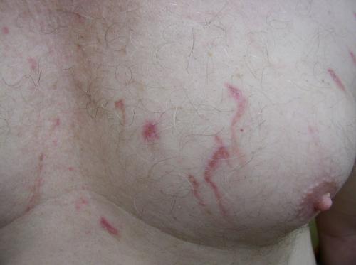 Phytophotodermatitis5