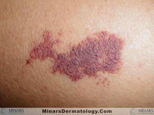 Port Wine Stain A