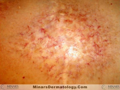Radiation Dermatitis 01 A