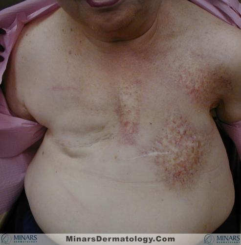Radiation Dermatitis 02 A