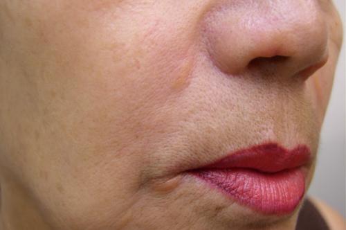 Silicone granuloma3